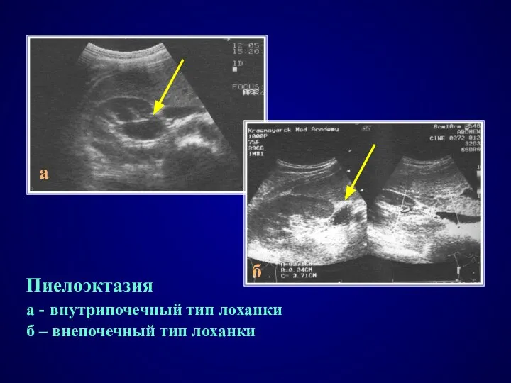 Пиелоэктазия а - внутрипочечный тип лоханки б – внепочечный тип лоханки а б