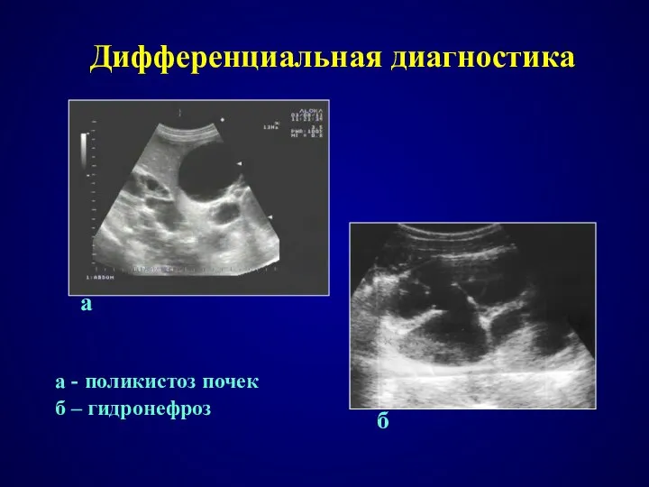 Дифференциальная диагностика а - поликистоз почек б – гидронефроз а б