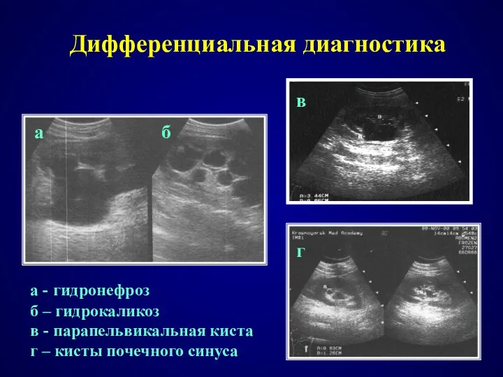 а - гидронефроз б – гидрокаликоз в - парапельвикальная киста г