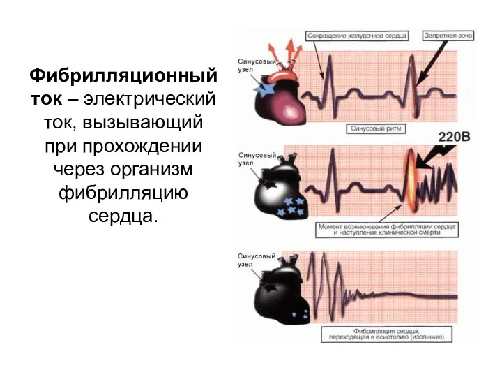 Фибрилляционный ток – электрический ток, вызывающий при прохождении через организм фибрилляцию сердца.