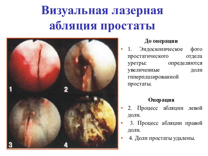 Визуальная лазерная абляция простаты До операции 1. Эндоскопическое фото простатического отдела