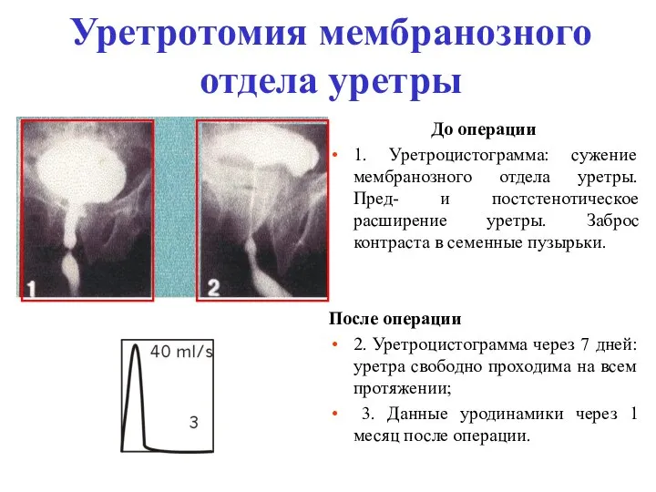 Уретротомия мембранозного отдела уретры До операции 1. Уретроцистограмма: сужение мембранозного отдела