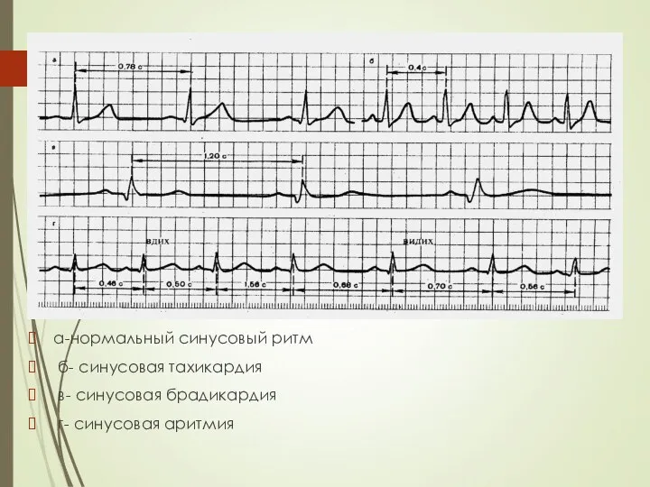 а-нормальный синусовый ритм б- синусовая тахикардия в- синусовая брадикардия г- синусовая аритмия