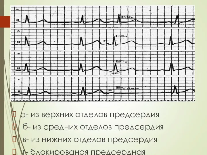 а- из верхних отделов предсердия б- из средних отделов предсердия в-