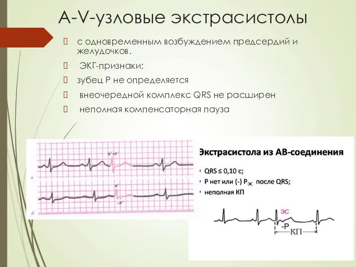 А-V-узловые экстрасистолы с одновременным возбуждением предсердий и желудочков. ЭКГ-признаки: зубец Р