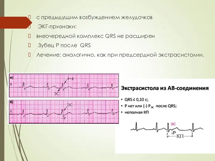 с предыдущим возбуждением желудочков ЭКГ-признаки: внеочередной комплекс QRS не расширен Зубец