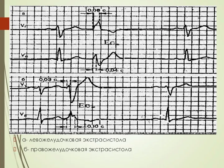 а- левожелудочковая экстрасистола б- правожелудочковая экстрасистола