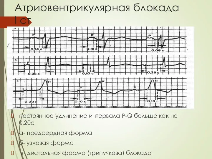 Атриовентрикулярная блокада I ст постоянное удлинение интервала P-Q больше как на