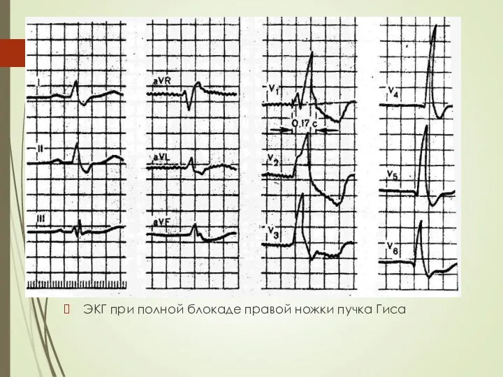ЭКГ при полной блокаде правой ножки пучка Гиса