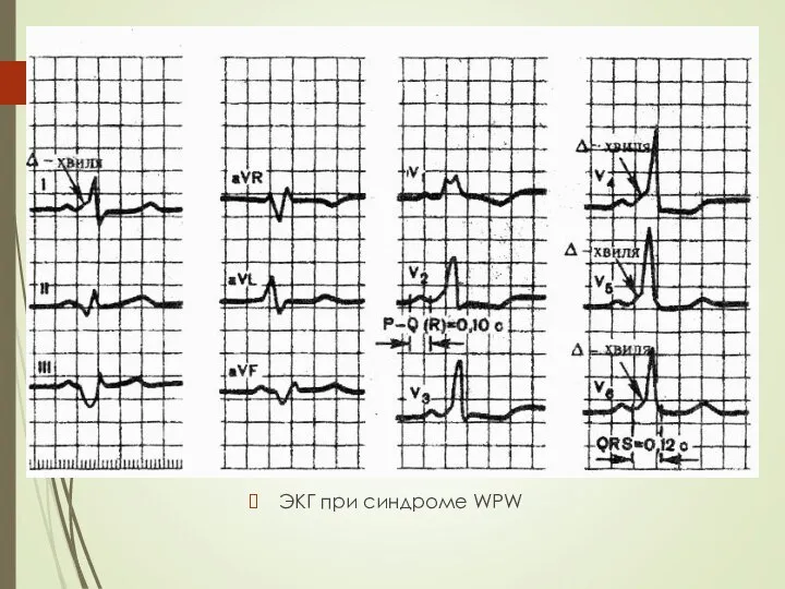 ЭКГ при синдроме WPW