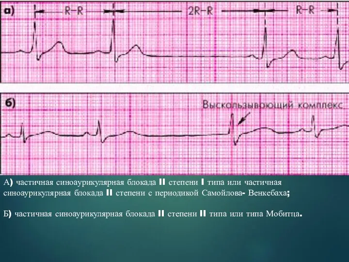 А) частичная синоаурикулярная блокада II степени I типа или частичная синоаурикулярная