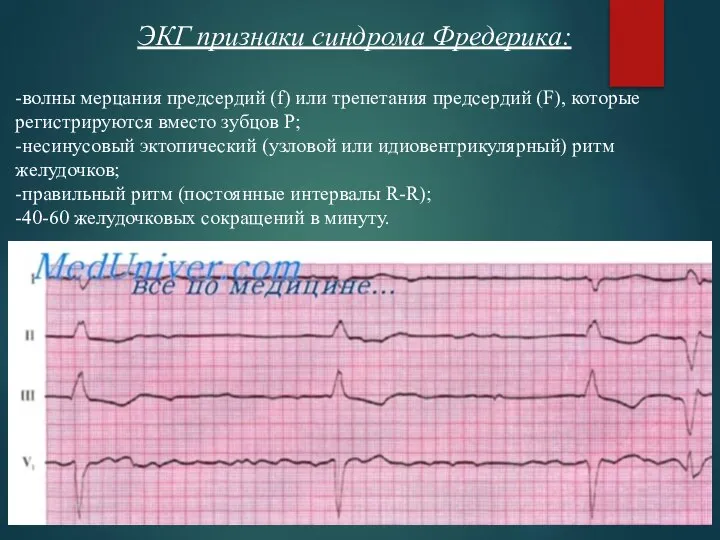 ЭКГ признаки синдрома Фредерика: -волны мерцания предсердий (f) или трепетания предсердий