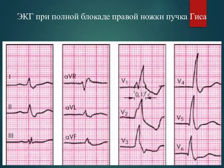 ЭКГ при полной блокаде правой ножки пучка Гиса