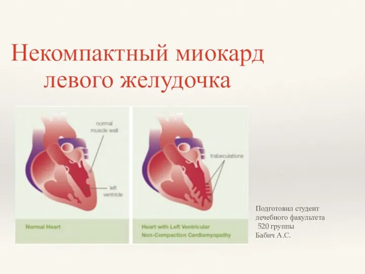 Некомпактный миокард левого желудочка