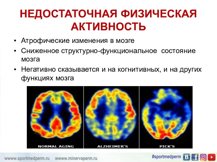 НЕДОСТАТОЧНАЯ ФИЗИЧЕСКАЯ АКТИВНОСТЬ Атрофические изменения в мозге Сниженное структурно-функциональное состояние мозга