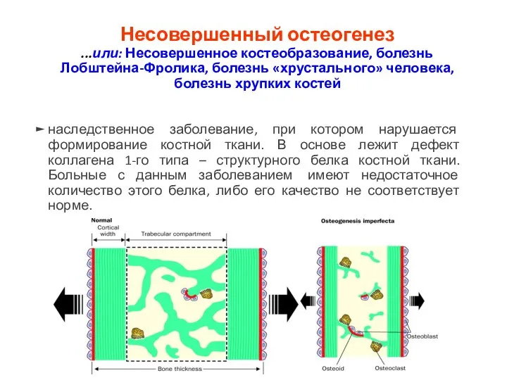 Несовершенный остеогенез ...или: Несовершенное костеобразование, болезнь Лобштейна-Фролика, болезнь «хрустального» человека, болезнь