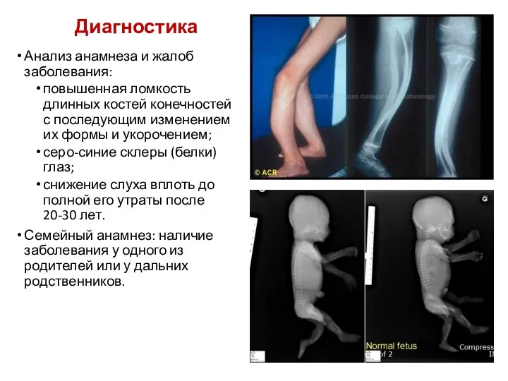 Диагностика Анализ анамнеза и жалоб заболевания: повышенная ломкость длинных костей конечностей