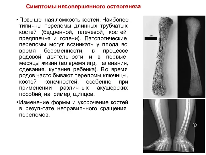 Симптомы несовершенного остеогенеза Повышенная ломкость костей. Наиболее типичны переломы длинных трубчатых