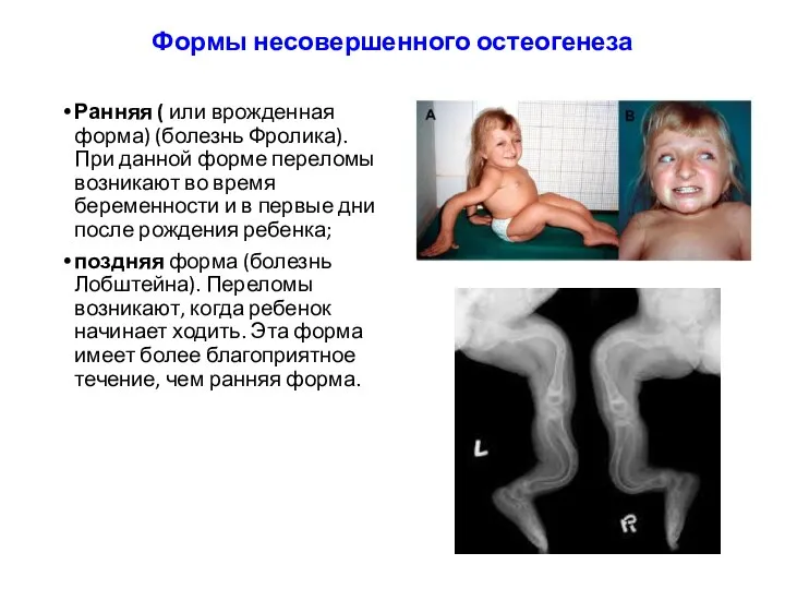 Формы несовершенного остеогенеза Ранняя ( или врожденная форма) (болезнь Фролика). При