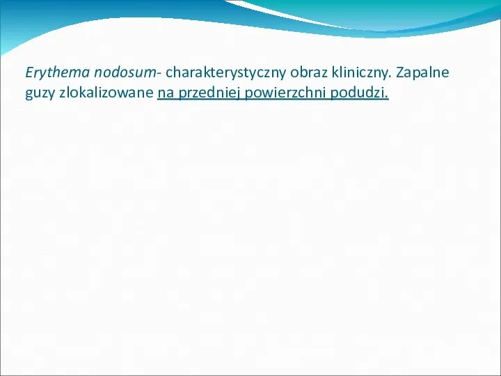 Erythema nodosum- charakterystyczny obraz kliniczny. Zapalne guzy zlokalizowane na przedniej powierzchni podudzi.