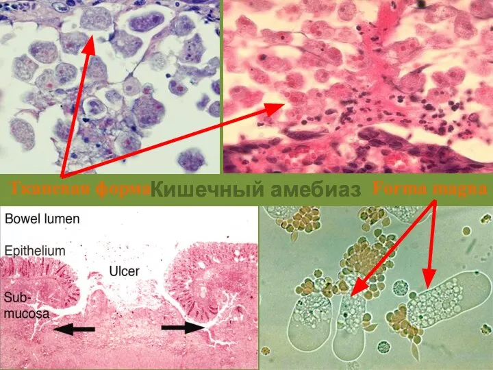 Кишечный амебиаз Forma magna Тканевая форма
