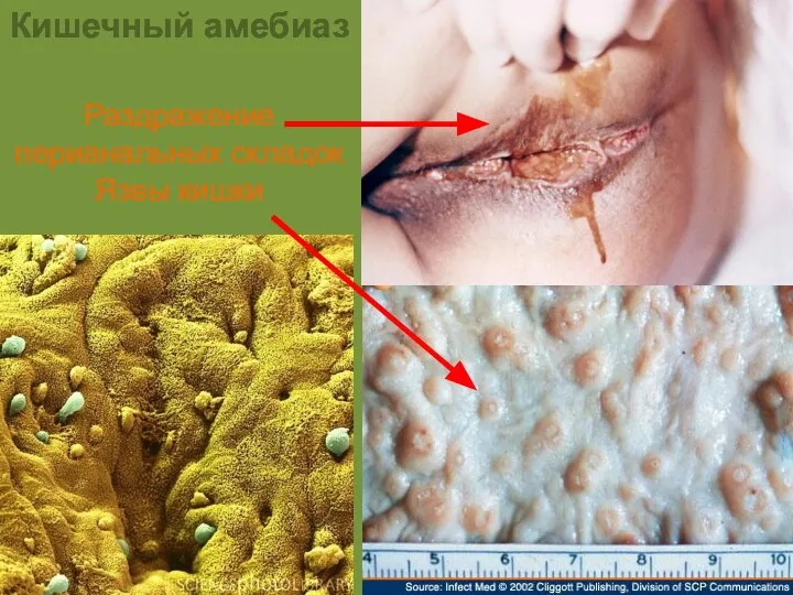 Кишечный амебиаз Раздражение перианальных складок Язвы кишки