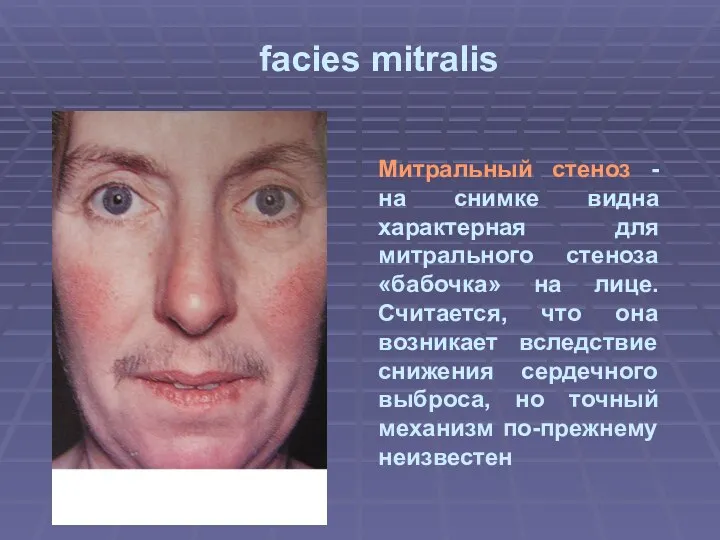 facies mitralis Митральный стеноз -на снимке видна характерная для митрального стеноза