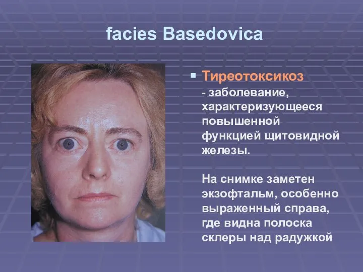 facies Basedovica Тиреотоксикоз - заболевание, характеризующееся повышенной функцией щитовидной железы. На