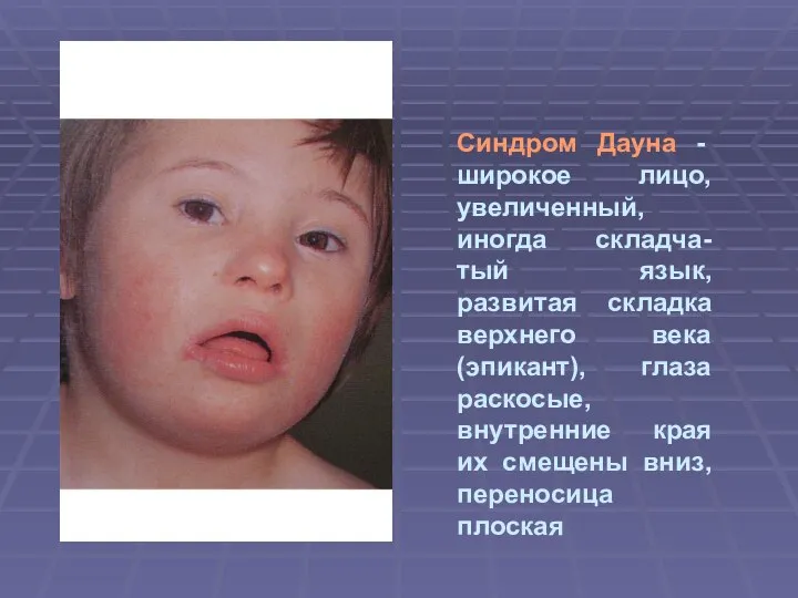 Синдром Дауна - широкое лицо, увеличенный, иногда складча-тый язык, развитая складка