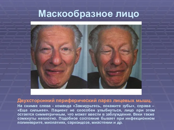 Маскообразное лицо Двухсторонний периферический парез лицевых мышц. На снимке слева -