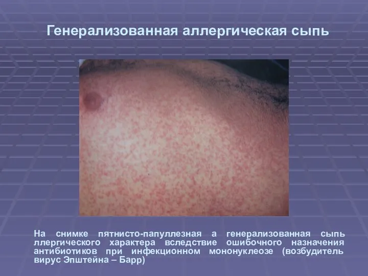 Генерализованная аллергическая сыпь На снимке пятнисто-папуллезная а генерализованная сыпь ллергического характера