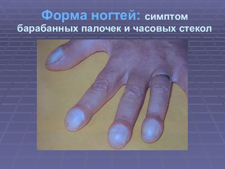 Форма ногтей: симптом барабанных палочек и часовых стекол