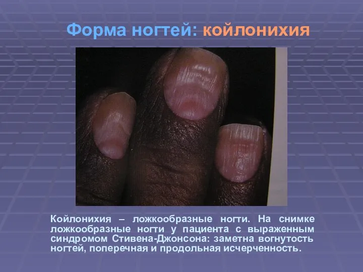 Форма ногтей: койлонихия Койлонихия – ложкообразные ногти. На снимке ложкообразные ногти