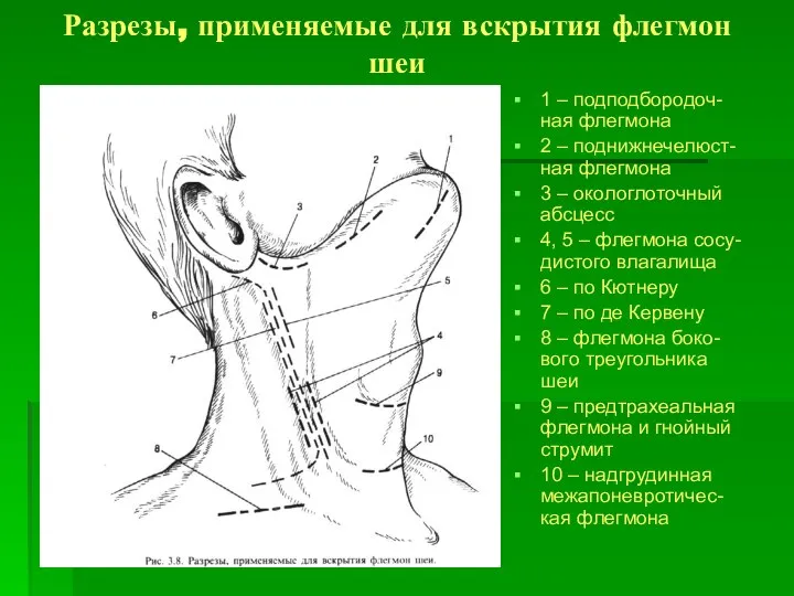 Разрезы, применяемые для вскрытия флегмон шеи 1 – подподбородоч-ная флегмона 2