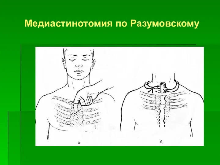 Медиастинотомия по Разумовскому