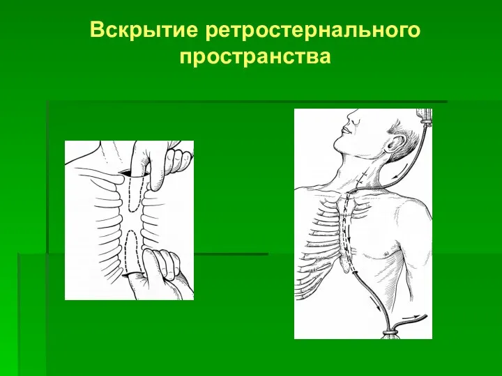 Вскрытие ретростернального пространства