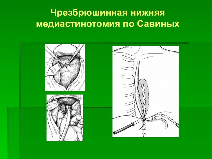 Чрезбрюшинная нижняя медиастинотомия по Савиных