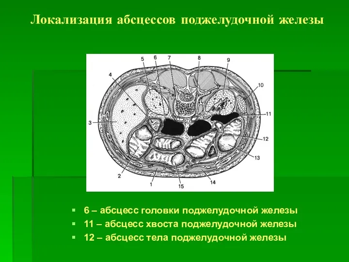 Локализация абсцессов поджелудочной железы 6 – абсцесс головки поджелудочной железы 11