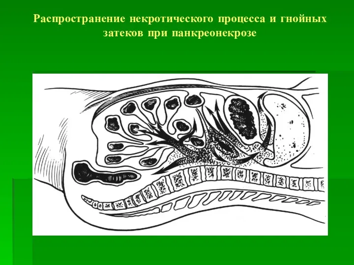 Распространение некротического процесса и гнойных затеков при панкреонекрозе