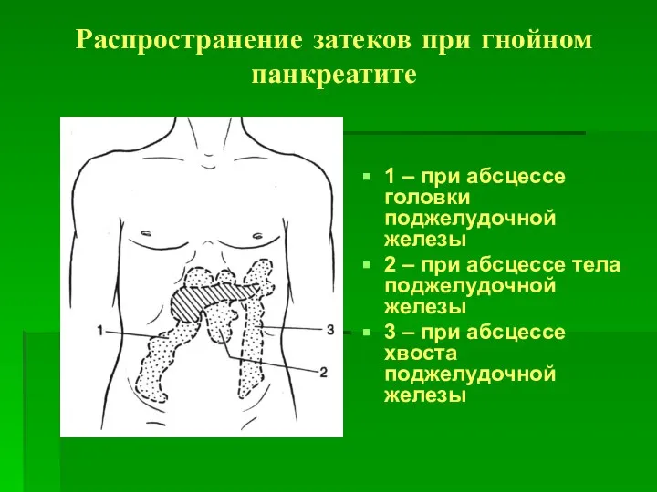 Распространение затеков при гнойном панкреатите 1 – при абсцессе головки поджелудочной