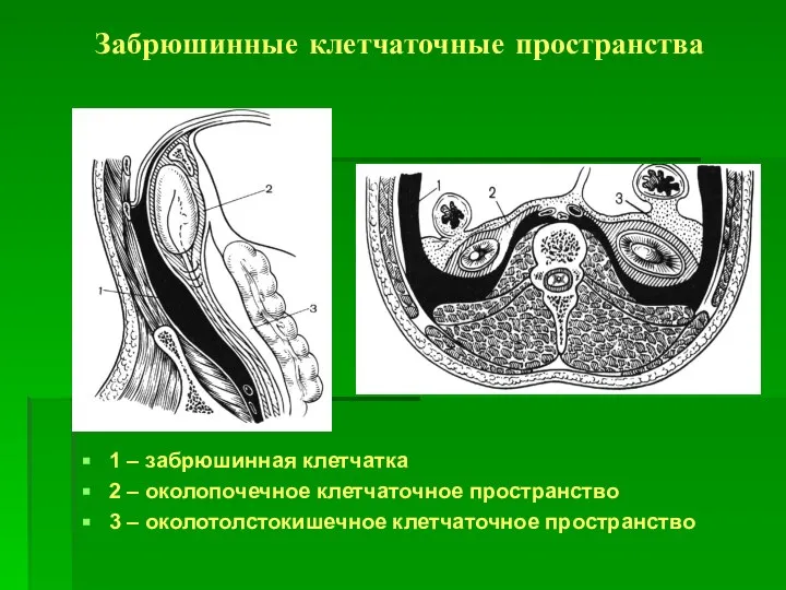 Забрюшинные клетчаточные пространства 1 – забрюшинная клетчатка 2 – околопочечное клетчаточное