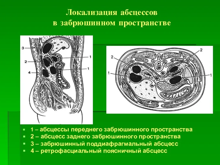 Локализация абсцессов в забрюшинном пространстве 1 – абсцессы переднего забрюшинного пространства