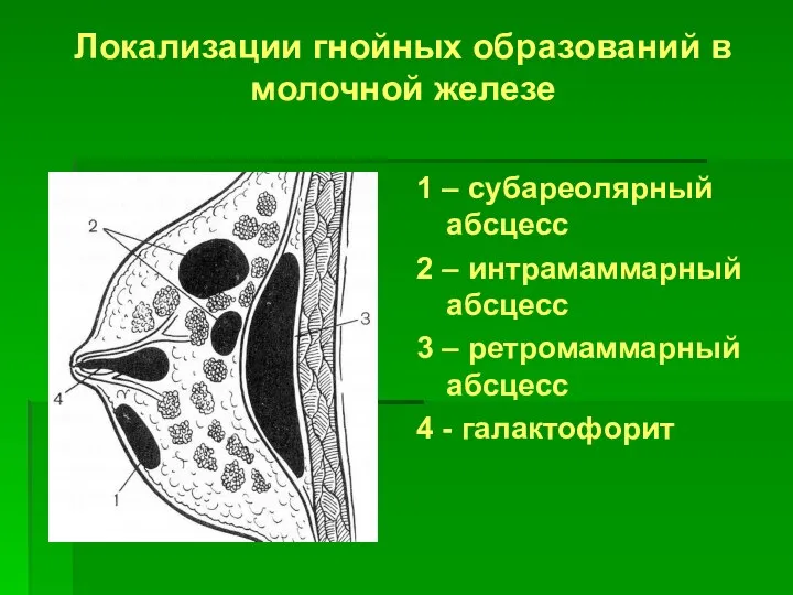 Локализации гнойных образований в молочной железе 1 – субареолярный абсцесс 2