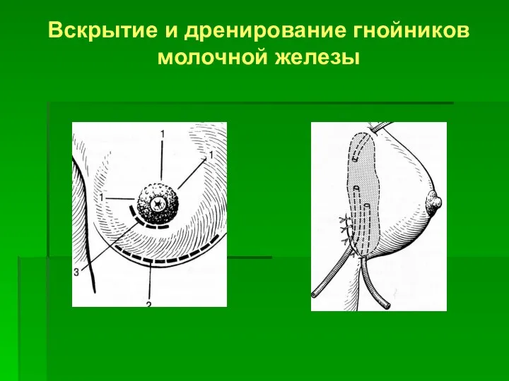 Вскрытие и дренирование гнойников молочной железы