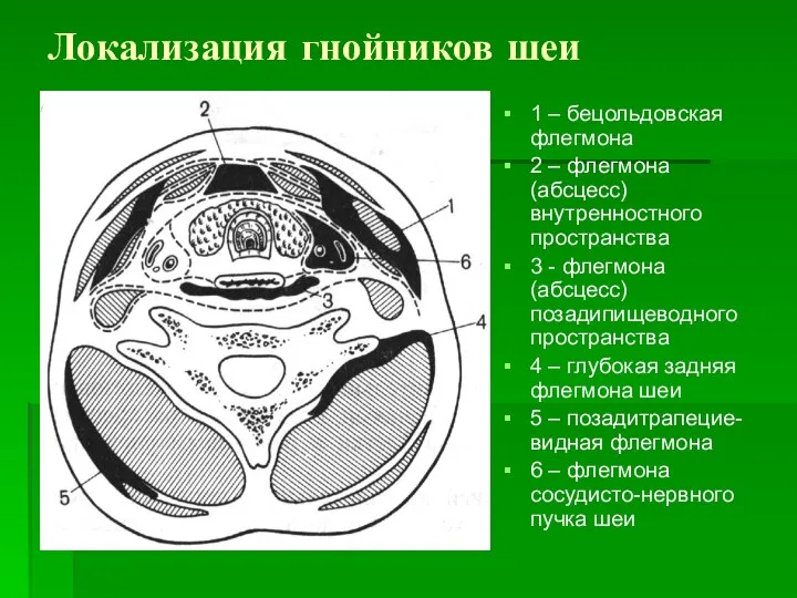 Локализация гнойников шеи 1 – бецольдовская флегмона 2 – флегмона (абсцесс)