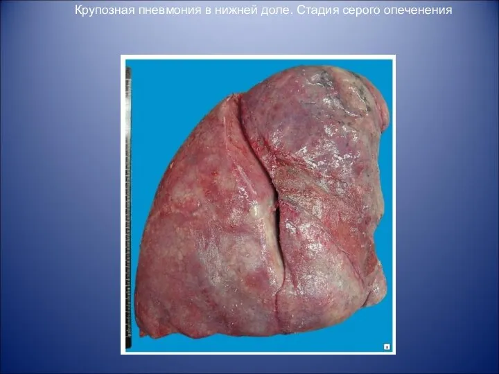 Крупозная пневмония в нижней доле. Стадия серого опеченения