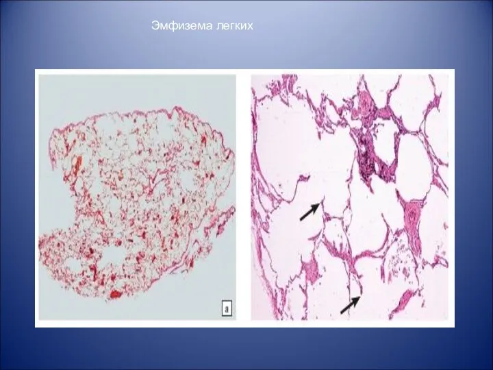Эмфизема легких