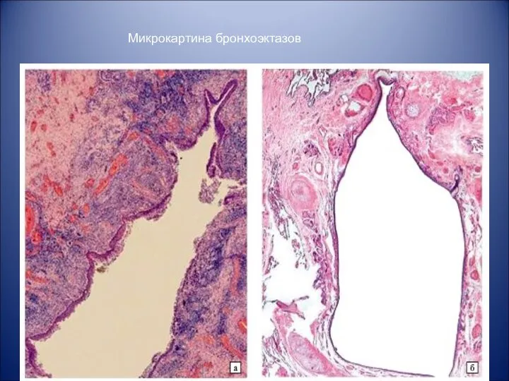 Микрокартина бронхоэктазов