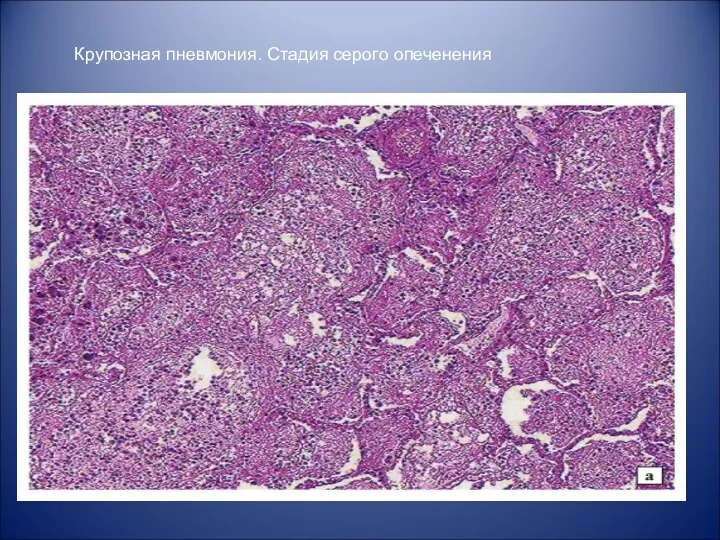 Крупозная пневмония. Стадия серого опеченения