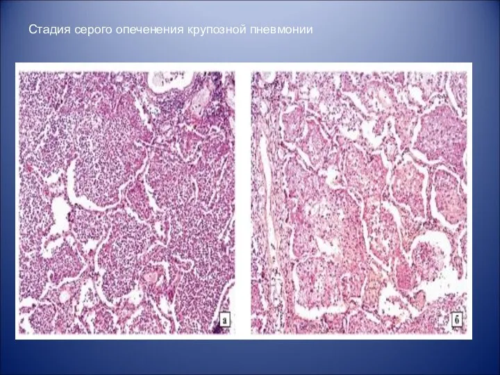 Стадия серого опеченения крупозной пневмонии